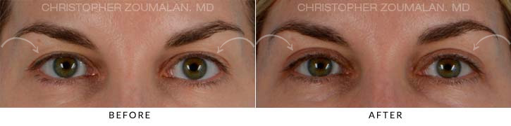 Upper Lid Blepharoplasty Before & After Photo - Patient Seeing Straight - Patient 20A