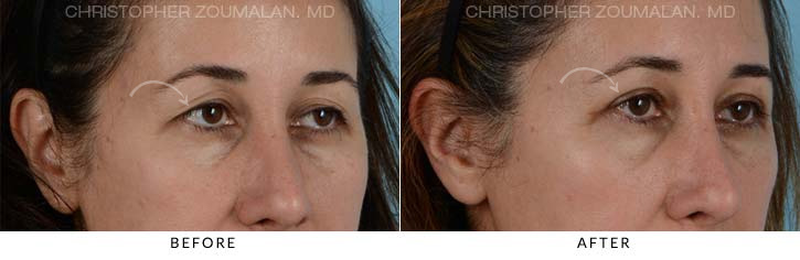 Upper Lid Blepharoplasty Before & After Photo - Patient Seeing Side - Patient 21A