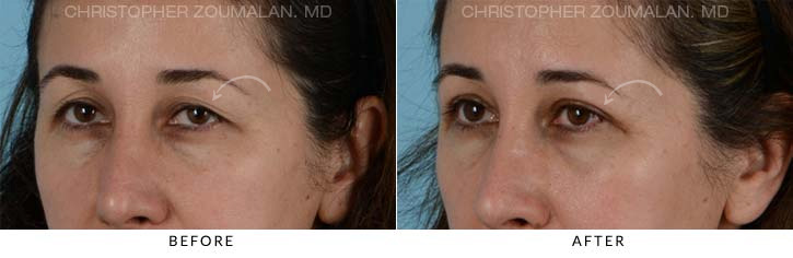 Upper Lid Blepharoplasty Before & After Photo - Patient Seeing Side - Patient 21B