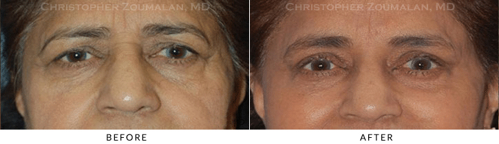 Upper Lid Blepharoplasty Before & After Photo -  - Patient 83