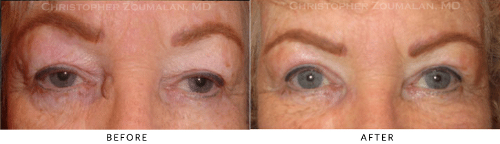 Upper Lid Blepharoplasty Before & After Photo -  - Patient 84