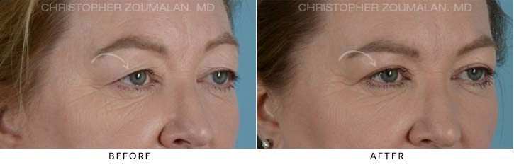 Upper Lid Blepharoplasty Before & After Photo - Patient Seeing Right - Patient 22A