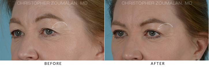 Upper Lid Blepharoplasty Before & After Photo - Patient Seeing Left - Patient 22B