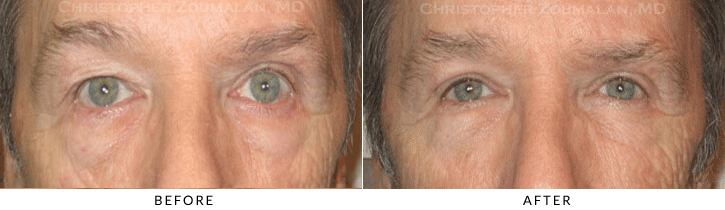 Upper Lid Blepharoplasty Before & After Photo -  - Patient 86