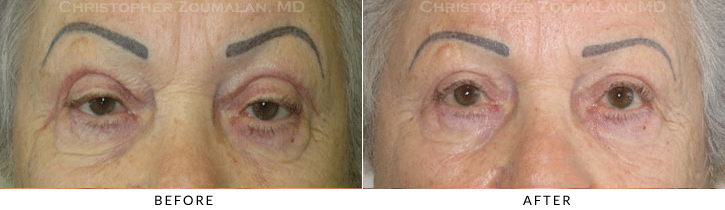 Upper Lid Blepharoplasty Before & After Photo -  - Patient 87