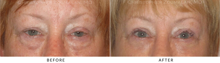 Upper Lid Blepharoplasty Before & After Photo -  - Patient 91