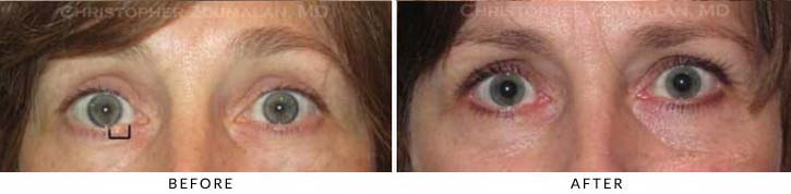 Eyelid Skin Cancer Excision Before & After Photo - Patient Seeing Straight - Patient 7