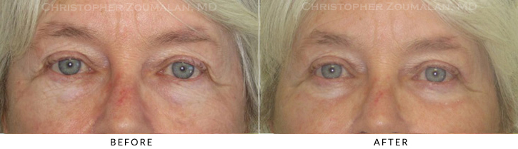 Upper Lid Blepharoplasty Before & After Photo -  - Patient 96