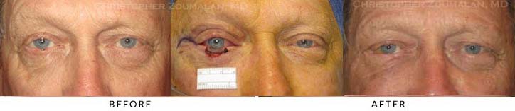 Eyelid Skin Cancer Excision Before & After Photo - Patient Seeing Straight - Patient 8