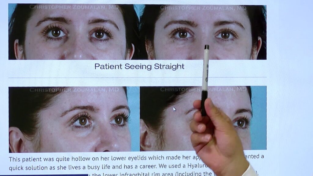 Non surgical blepharoplasty procedure - Click to see video