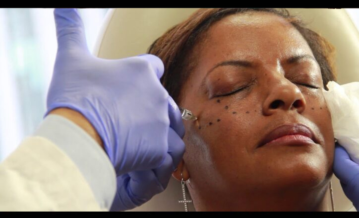 Cheek augmentation with juvederm voluma procedure - Click to see video