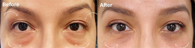 Upper and lower Blepharoplasty before and after picture of a patient