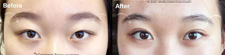 Beautiful before and after picture of an UPPER LID BLEPHAROPLASTY AND PTOSIS REPAIR