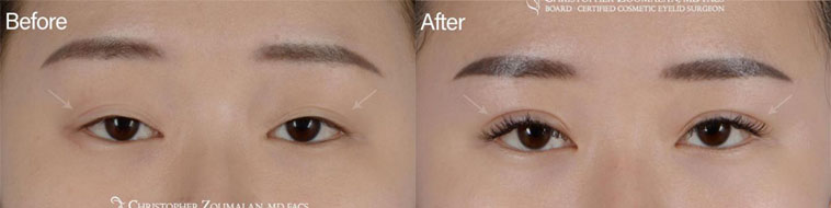 Beautiful Asian eyelid surgery done in our office under local anesthesia - Female Patient before and after picture