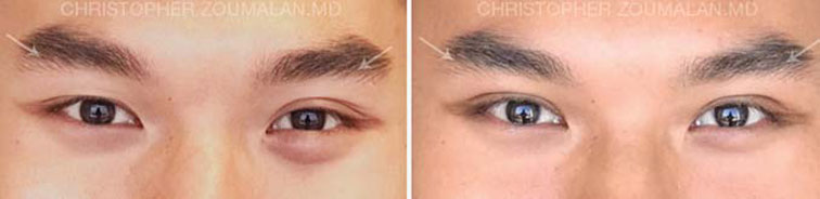 Asian eyelid surgery - male patient before and after picture