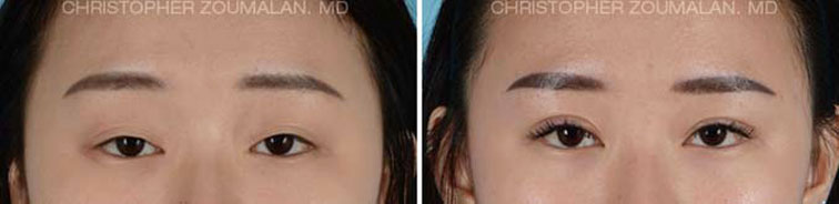 Lower lid blepharoplasty using Natural Looking Blepharoplasty Technique - female Patient before and after picture