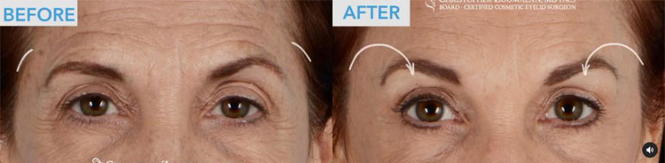 Beautiful upper eyelid and brow enhancement from an endoscopic brow lift, and upper eyelid blepharoplasty, and CO2 laser to the lower eyelids - female patient before and after picture