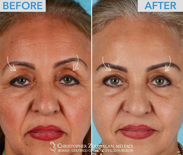 Skin only blepharoplasty combined with a Ptosis repair to open up her droopy eyes - female patient before and after picture