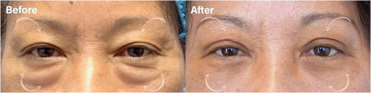 Beautiful UPPER EYELID BLEPHAROPLASTY to improve excess upper lid skin. - male patient before and after picture