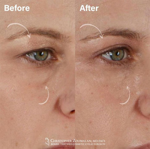 The quad blepharoplasty procedure combines the upper and lower eyelid blepharoplasty procedures - female patient before and after picture