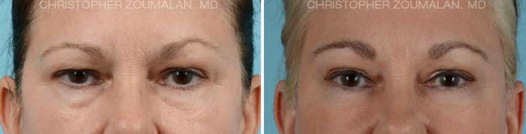 Tear trough hollow refers to hollowing along the eyelid closer to the nose - female patient before and after picture