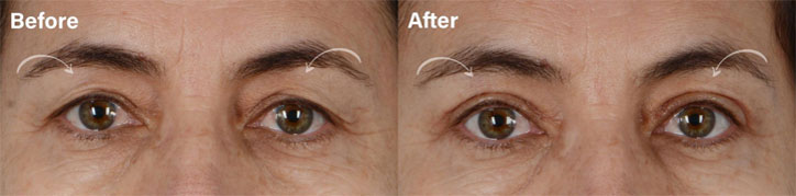 Every patient heals a bit differently, some may be more swollen than others, and ultimately it continues to improve week to week. - male patient before and after picture