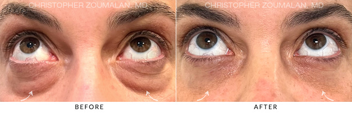 Lower Lid Blepharoplasty Before & After Photo - Patient Seeing Up - Patient 6B