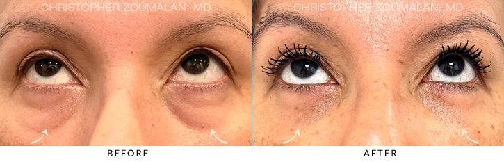 Lower Lid Blepharoplasty Before & After Photo - Patient Seeing Up - Patient 7B