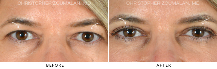 Upper Lid Blepharoplasty Before & After Photo - Patient Seeing Straight - Patient 10A