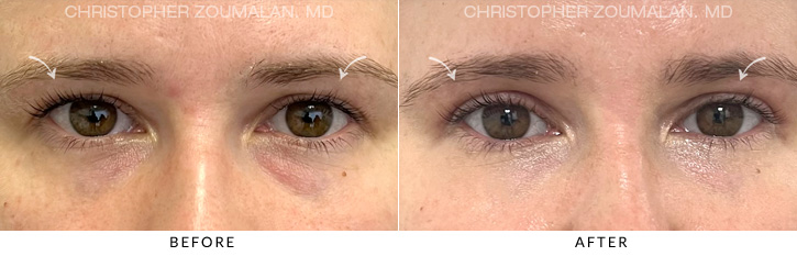 Upper Lid Blepharoplasty Before & After Photo - Patient Seeing Straight - Patient 11A