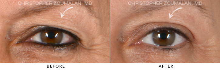 Upper Lid Blepharoplasty Before & After Photo - Patient Seeing Straight - Patient 13A