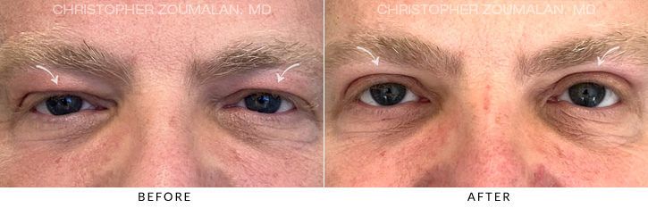 Upper Lid Blepharoplasty Before & After Photo - Patient Seeing Straight - Patient 15A