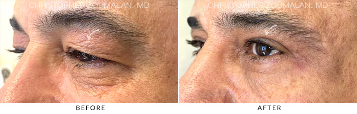 Upper Lid Blepharoplasty Before & After Photo - Patient Seeing Side - Patient 16C