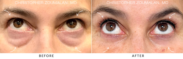 Quad Blepharoplasty Before & After Photo - Patient Seeing Up - Patient 8B