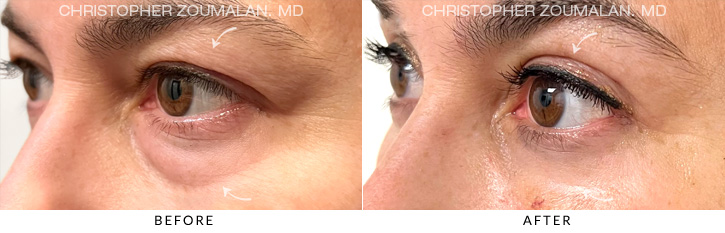 Quad Blepharoplasty Before & After Photo - Patient Seeing Side - Patient 8C