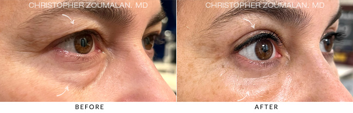 Quad Blepharoplasty Before & After Photo - Patient Seeing Side - Patient 8D