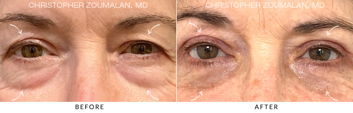 Quad Blepharoplasty Before & After Photo - Patient Seeing Straight - Patient 9A