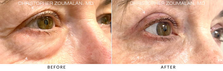 Quad Blepharoplasty Before & After Photo - Patient Seeing Side - Patient 9C