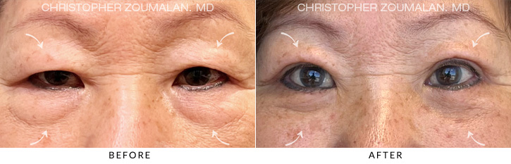 Quad Blepharoplasty Before & After Photo - Patient Seeing Straight - Patient 10A