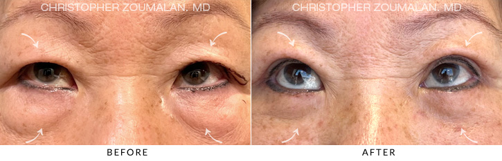 Quad Blepharoplasty Before & After Photo - Patient Seeing Up - Patient 10B