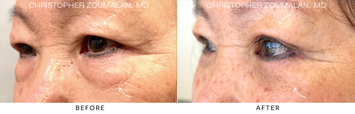 Quad Blepharoplasty Before & After Photo - Patient Seeing Side - Patient 10C