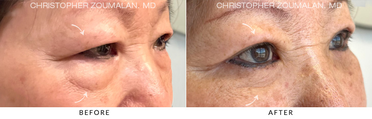 Quad Blepharoplasty Before & After Photo - Patient Seeing Side - Patient 10D