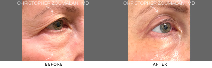 Quad Blepharoplasty Before & After Photo - Patient Seeing Side - Patient 5B