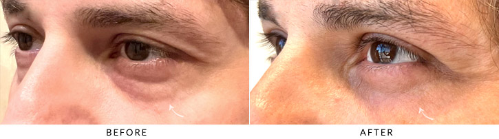 Male Blepharoplasty Before & After Photo - Patient Seeing Side - Patient 1C