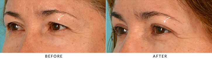 Upper Lid Blepharoplasty Before & After Photo - Patient Seeing Side - Patient 1D