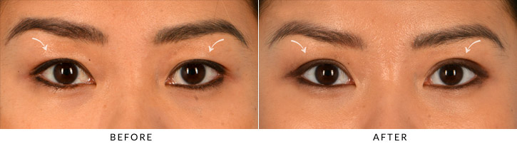 Upper Lid Blepharoplasty Before & After Photo - Patient Seeing Straight - Patient 6A