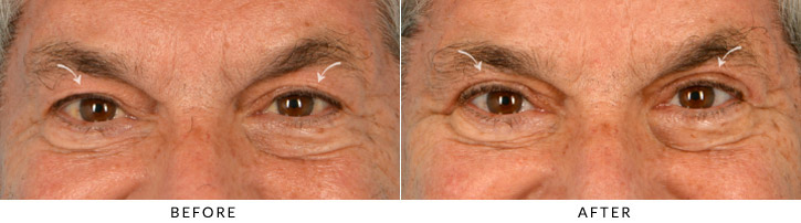 Male Blepharoplasty Before & After Photo - Patient Seeing Straight - Patient 2A