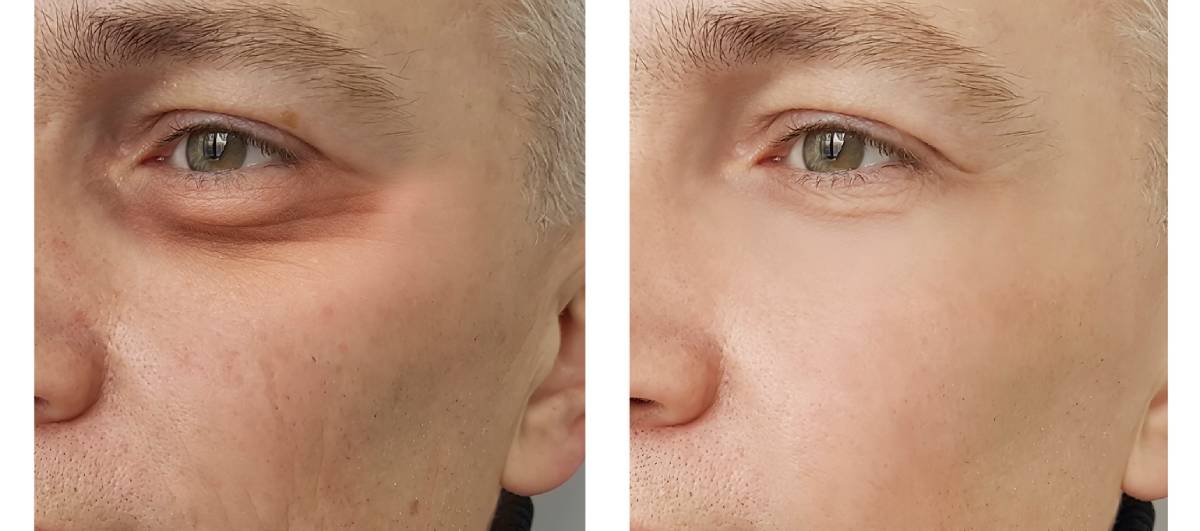 Featured image for Guide to Male Blepharoplasty